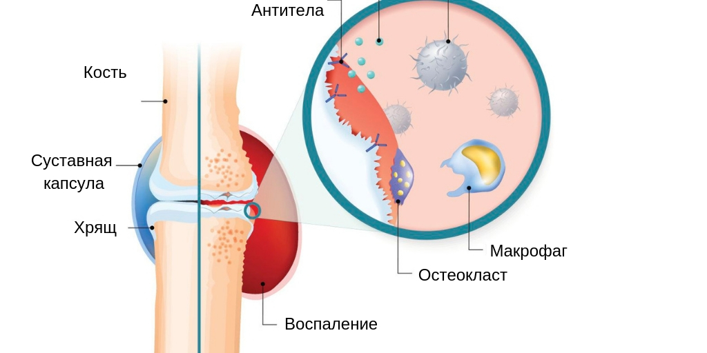 Ревматоидный артрит патогенез схема